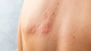 Bolhas pelo corpo: conheça sintomas e tratamento do Herpes Zoster